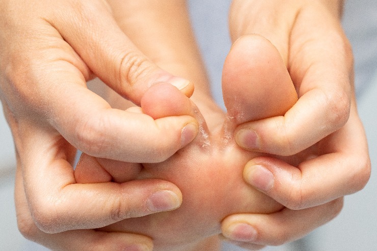 Tinea pedis, lidově „atletická noha". Možná jste si mysleli, že máte suché nohy. Ne, nemáte. Roste vám na nich plíseň. (zdroj: Shutterstock) m shutterstock 1481987558