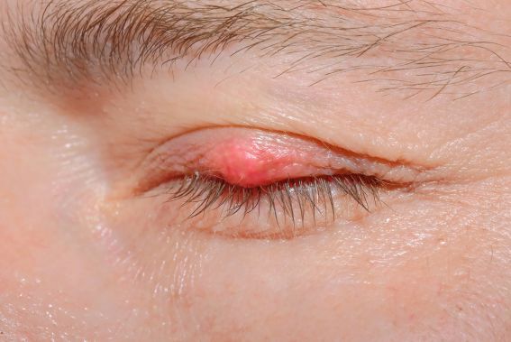 Na oku se přemnožený Demodex projevuje třeba takto. (foto: Shutterstock) shutterstock 2240290981