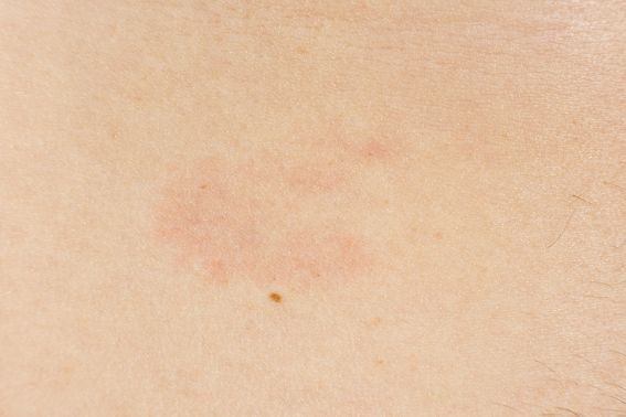 I takto může „typická“ skvrna po kousnutí klíštětem vypadat. (foto: Shutterstock) shutterstock 2799998417
