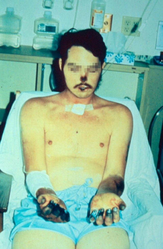Pacient zasažený dýmějovým morem (zdroj: Wikimedia Commons) 640px acral necrosis due to bubonic plague
