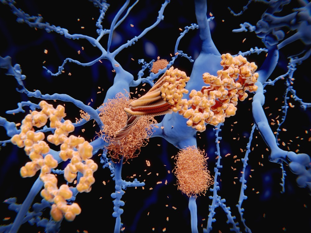 3D zobrazení amyloidního plaku v mozku postiženém Alzheimerovou chorobou. (zdroj: Shutterstock) m shutterstock 1157052994
